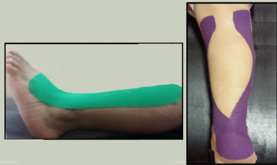 Imágenes obtenidas del artículo original Effect of Different Kinesio Taping Applications on Ankle Range in Children with Spastic Cerebral Palsy: A Comparative Study