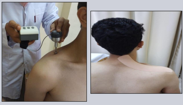 Imágenes obtenidas del artículo “Efficacy of Kinesio tape on pressure pain threshold and normalized resting Myoelectric activity on upper Trapezius Myofascial Trigger points (a randomized clinical trial)”. 